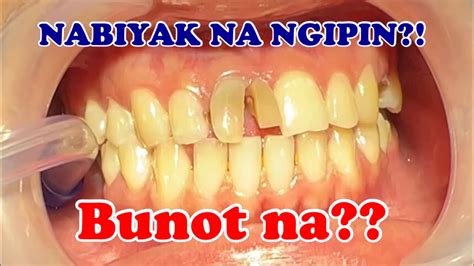 bunot ng ngipin in english